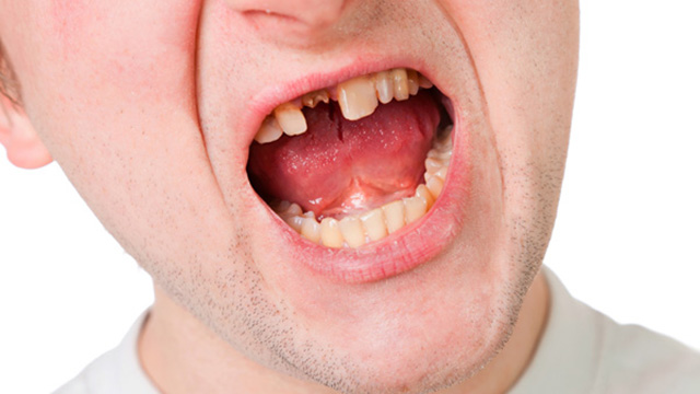 ▲牙周病的發生除了與厭氧菌有關，咬合不正導致牙齒過度受力，使牙齒受損，也會增加牙周病復發的風險。（圖／ingimage）