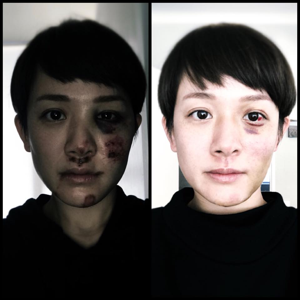 ▲林彥君騎車狠摔毀容。（圖／翻攝自臉書 , 2018.3.17）