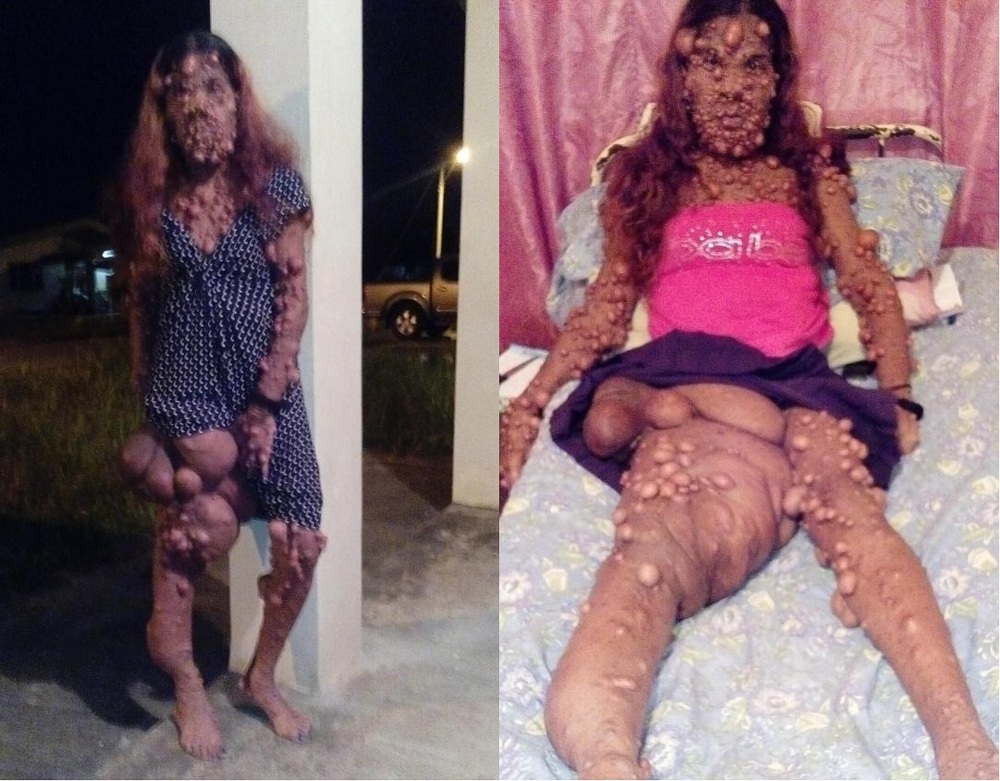 ▲一名38歲媽媽莎哈德歐（ Charmaine Sahadeo ）罹患怪病，全身上下佈滿數千腫瘤，近日拍攝影片尋求海外醫療。（圖／翻攝自英國《太陽報》）