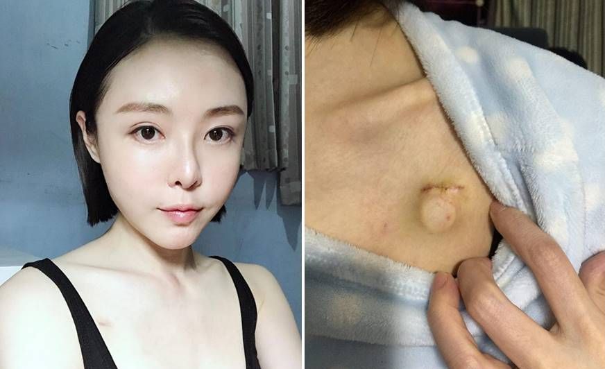 ▲李沁凝PO出自己裝「人工血管」的印記（右）。（圖／翻攝李沁凝臉書，2018.04.07）