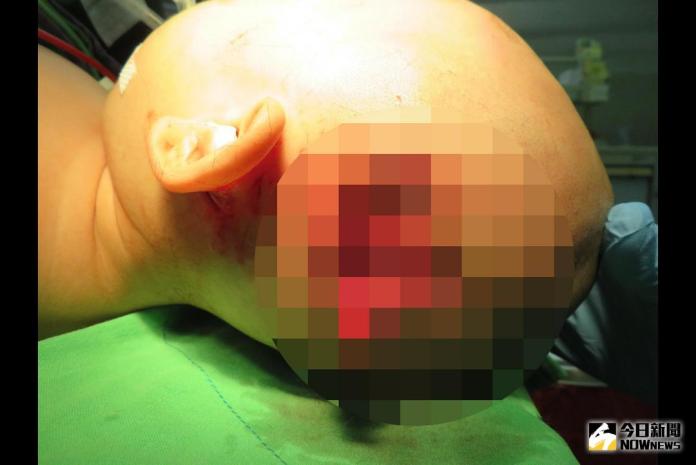比特犬咬傷頭顱　1歲男童奇蹟復原
