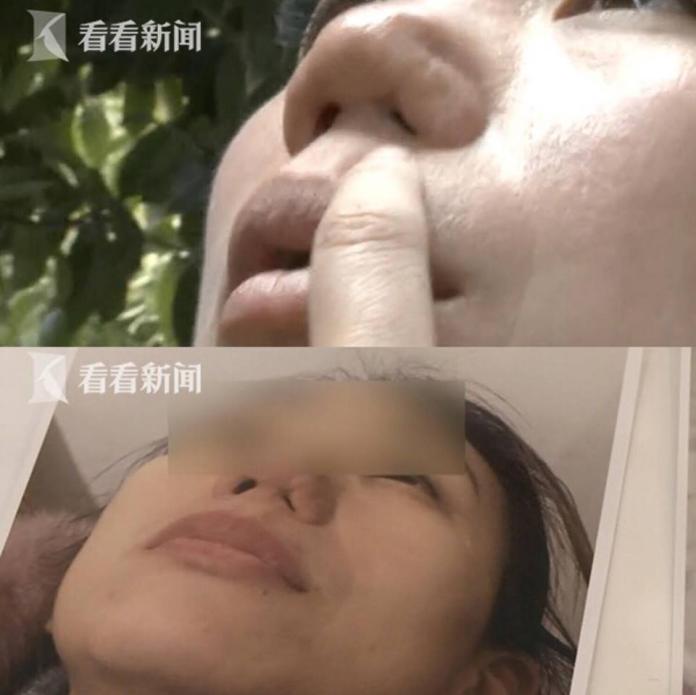 離譜！員工在自家醫院整鼻失敗　鼻孔不見險窒息
