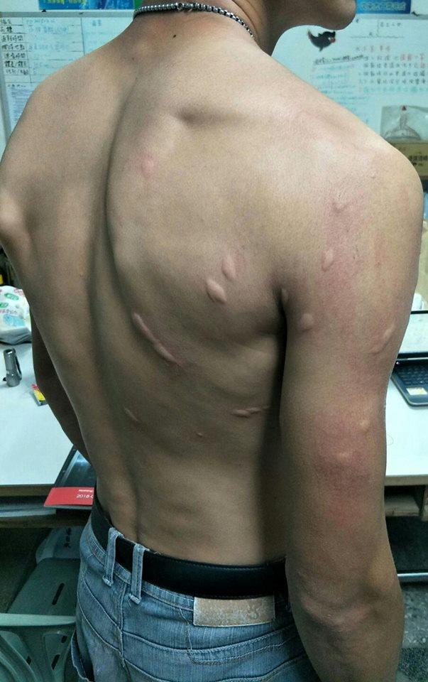 ▲男子身體多處被蚊子叮咬，竟嚴重到因「蜂窩性組織炎」住院。（圖／取自爆廢公社網站）