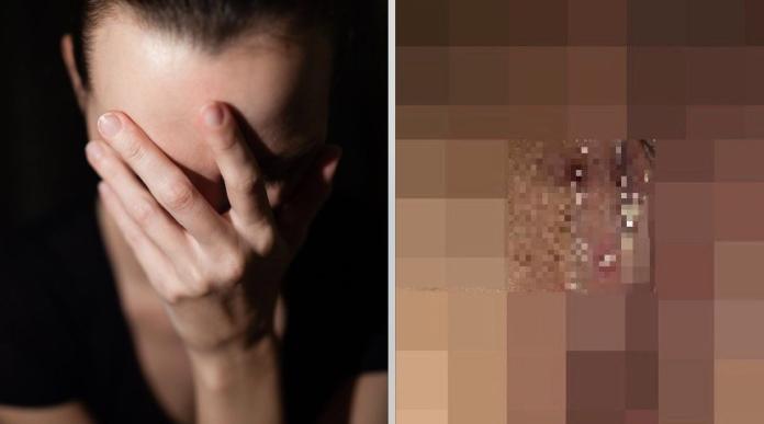 ▲日本一名 23 歲女網友約炮 50 男後慘得「化膿疱疹」，讓她欲哭無淚。（合成圖／翻攝自 5ch , 2018.5.11）