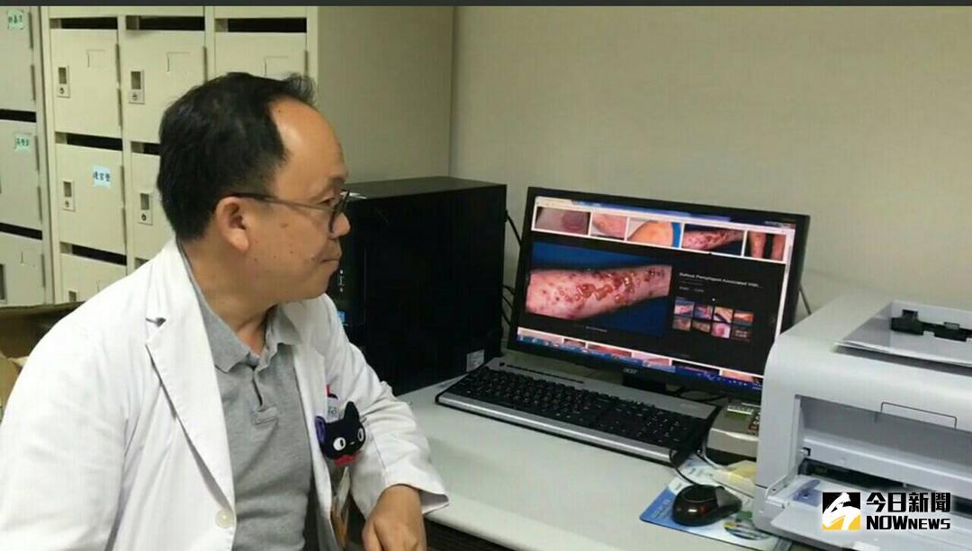 ▲彰化醫院免疫風濕科主任高堅凱說 ，長期搔癢全身冒水泡 ， 是「類天皰瘡」。（圖／唐詠絮攝，2018.05.14）