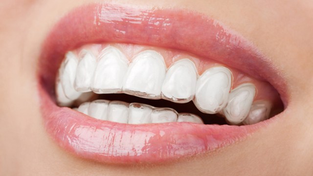 ▲隱形牙套矯正療程時，也可以同步進行，達到微整形效果。（圖／ingimage）
