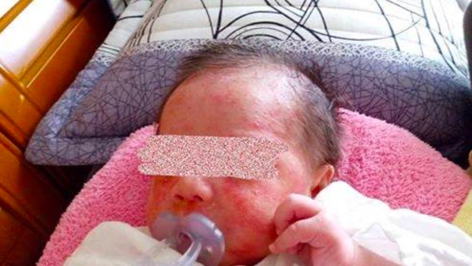 ▲方女控訴該名月嫂疑似為了省事，竟然用薑水幫初生嬰兒洗澡，洗完也沒擦乳液保濕，結果寶寶最後患得嚴重濕疹，整個臉上都長滿紅紅的疹子。（圖／翻攝自爆料公社 , 2018.5.27）