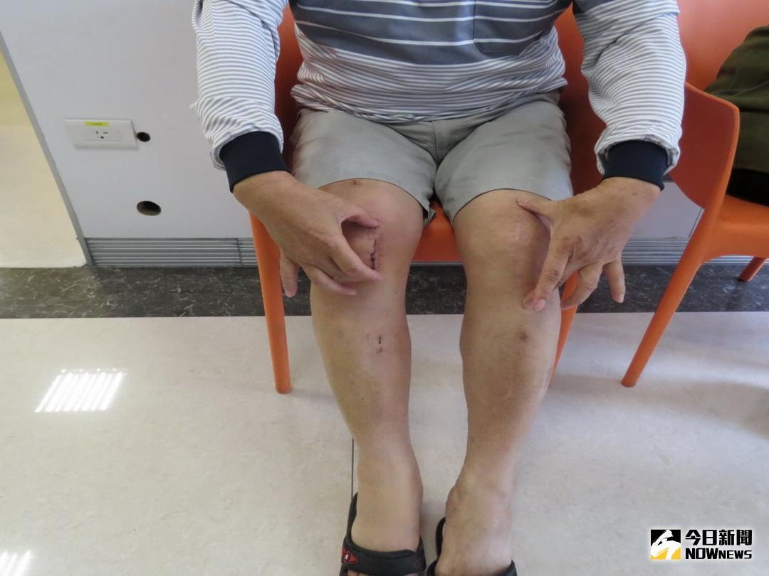 ▲機器手臂開膝安全又恢復快（圖／林重鎣攝 , 2018.6.15\\)