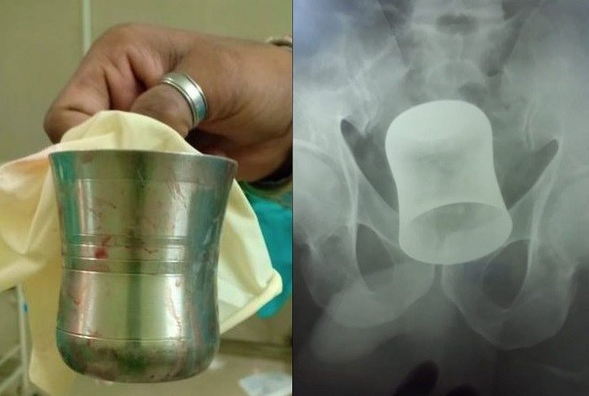 ▲印度一名男子肚子痛，去就醫時發現有鋼杯卡在肛門裡。（圖／翻攝自《都市報》）
