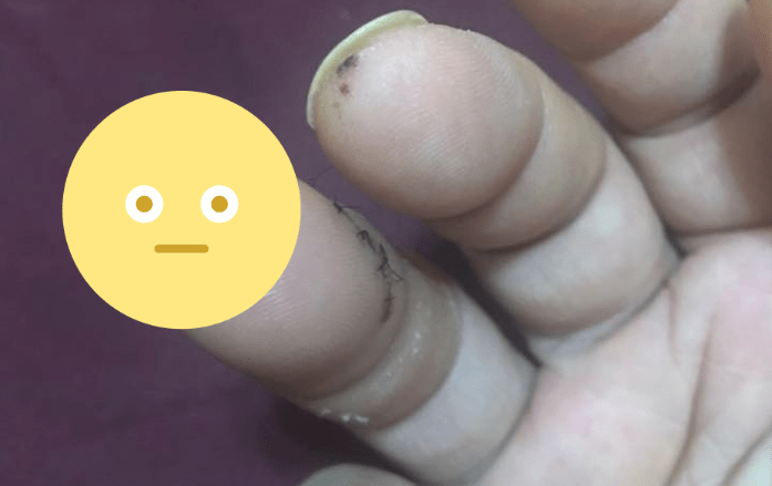 ▲歌手江明學PO出手指打上鋼釘的驚悚照。（圖／翻攝江明學臉書 , 2018.07.26）