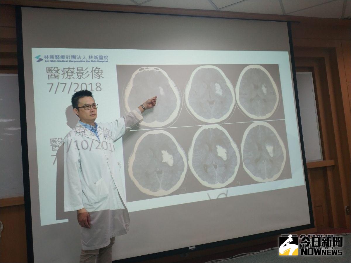 林新醫院高定憲醫師說明患者血塊繼續擴大病情(圖／金武鳳攝2018.9.5)