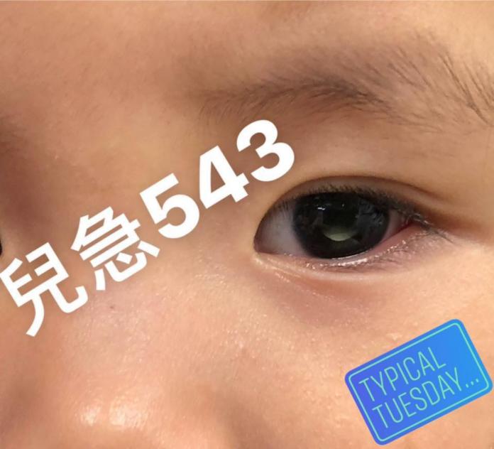 ▲一名 3 歲女童的父母發現女兒眼中有白點，就醫後證實罹患「視網膜母細胞瘤」，可能因此失去視力及眼睛。（圖／取自來講兒科急診的543-吳昌騰醫師 臉書）