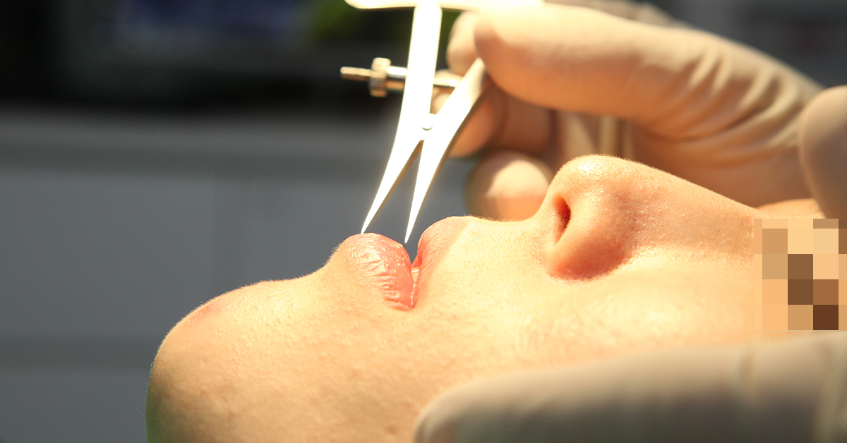 ▲眼鼻的整形以往都是五官雕塑的大宗，但近年來，隨著唇妝的普及化，大眾對於嘴唇的美感也越來越重視。（圖／蘇皇銓醫師提供）