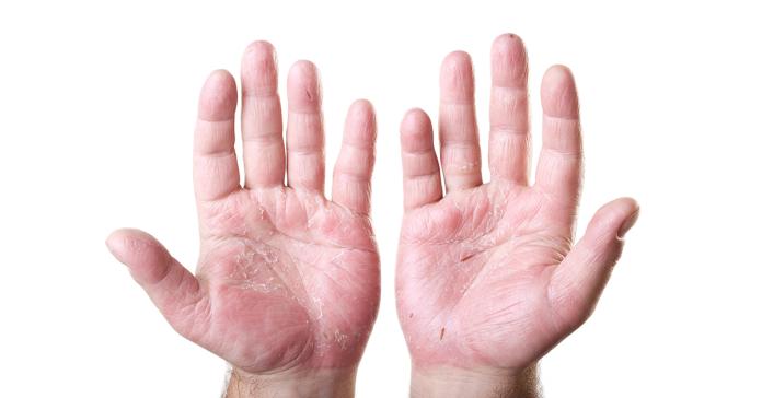 ▲乾癬是1種皮膚慢性發炎角化的疾病，尤其好發於秋冬季節。天冷時人體的皮脂腺分泌減少、皮膚變得乾燥，多數會從頭皮及前額處開始冒出紅疹且皮屑變多。（圖／ingimage）