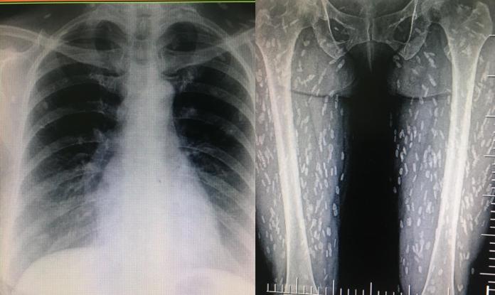 女子生吃豬肉…照X光「上百寄生蟲」在體內
