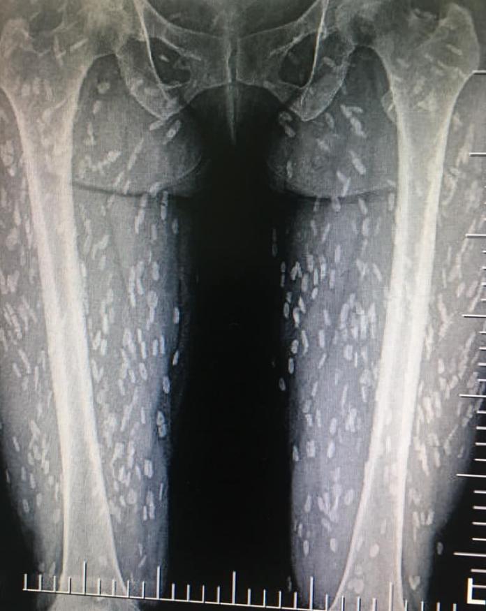▲女子腿部已經被大量寄生蟲佔據。（圖／翻攝自Kwang Volemage臉書）