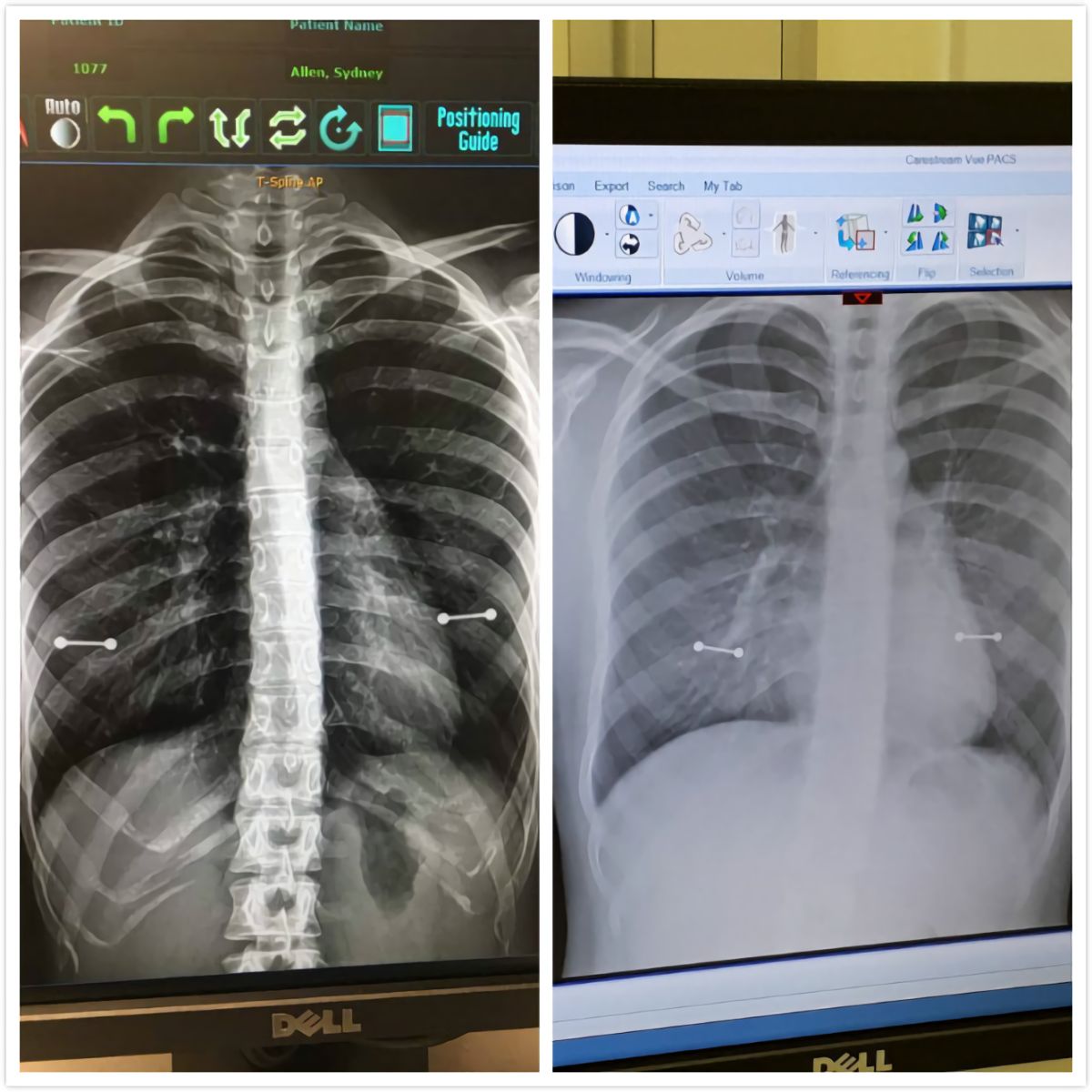 ▲女子照 X 光胸前驚見 2 條金屬槓，媽媽看後瞬間變臉。（圖／翻攝自推特）