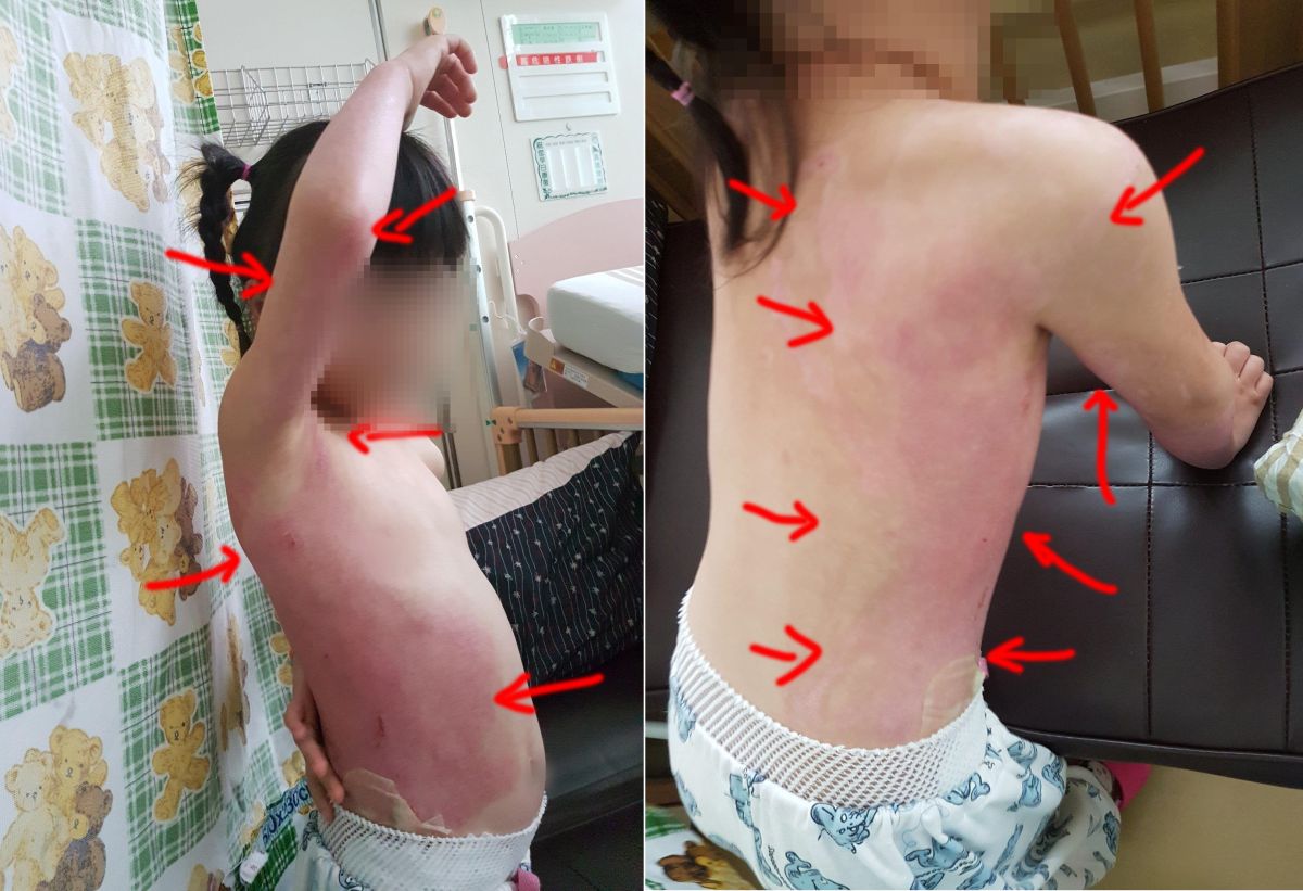 ▲家長PO文控訴女兒在幼兒園遭熱湯大面積燙傷，園方當下延誤處置，事後還冷處理。（圖／翻攝自爆料公社, 2018.11.12）