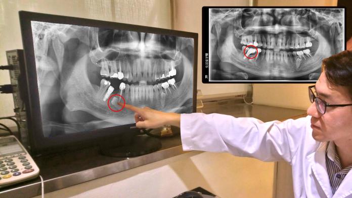 （圖一）多生牙是植牙不速之客？ 空間足夠未必不可行