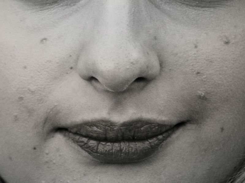 ▲食藥署表示，口服Ａ酸因因具有致畸胎性，服用前中後期都要嚴格避孕，且肝腎功能不全者也應該避免服用。（圖／擷取自pixabay）