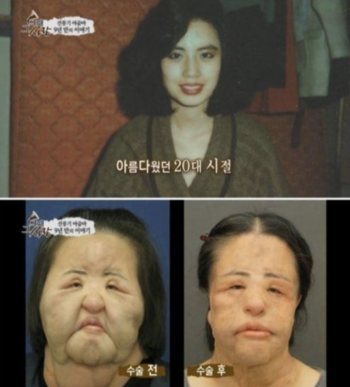韓國「電風扇大媽」因整容失敗，臉部嚴重變形。（圖／翻攝網路）