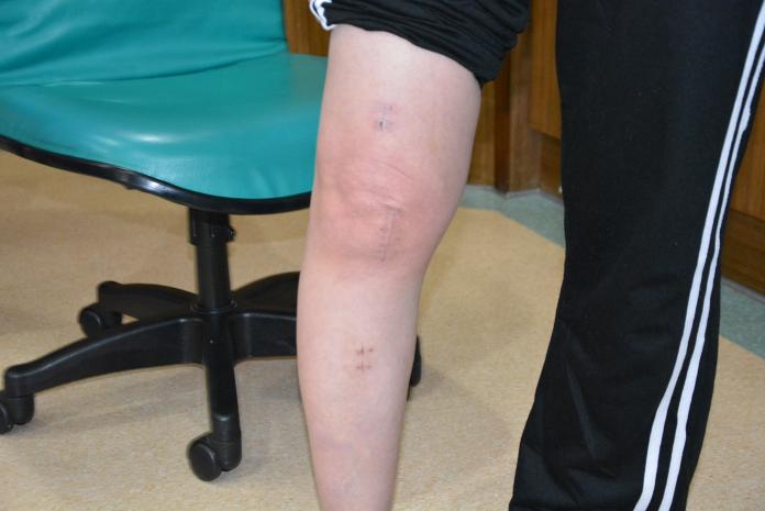 膝關節治療新選擇　機器人手臂人工關節置換術
