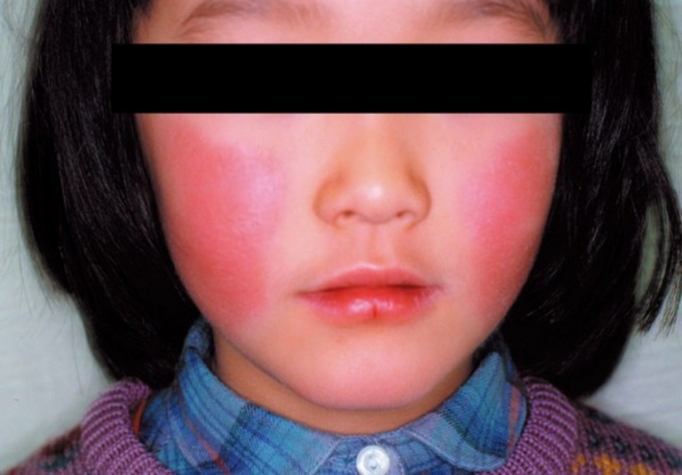 ▲日本關東地區近期出現俗稱「蘋果病」的傳染性紅斑病（Erythema infectiosum，リンゴ病）疫情。（圖／翻攝日本國立傳染病研究所）