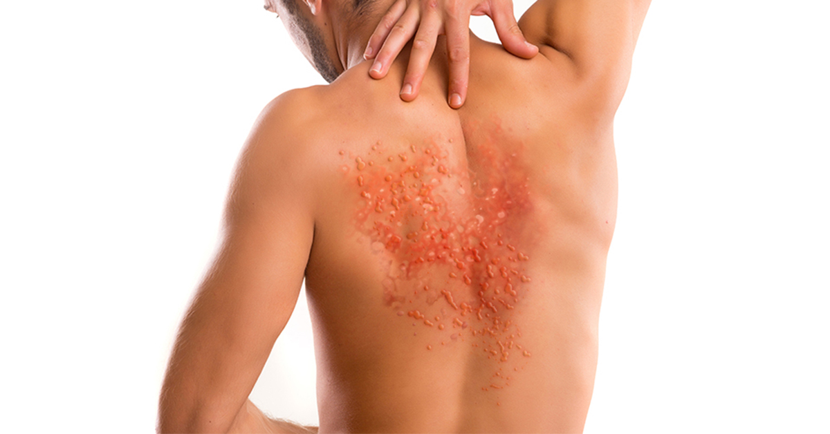 ▲帶狀疱疹俗稱皮蛇或飛蛇，帶狀疱疹在任何部位都可能發生，7至8成病患會出現於胸部、腰部，其次為頸部、頭部、顏面神經等部位。（圖／健康傳媒製作）