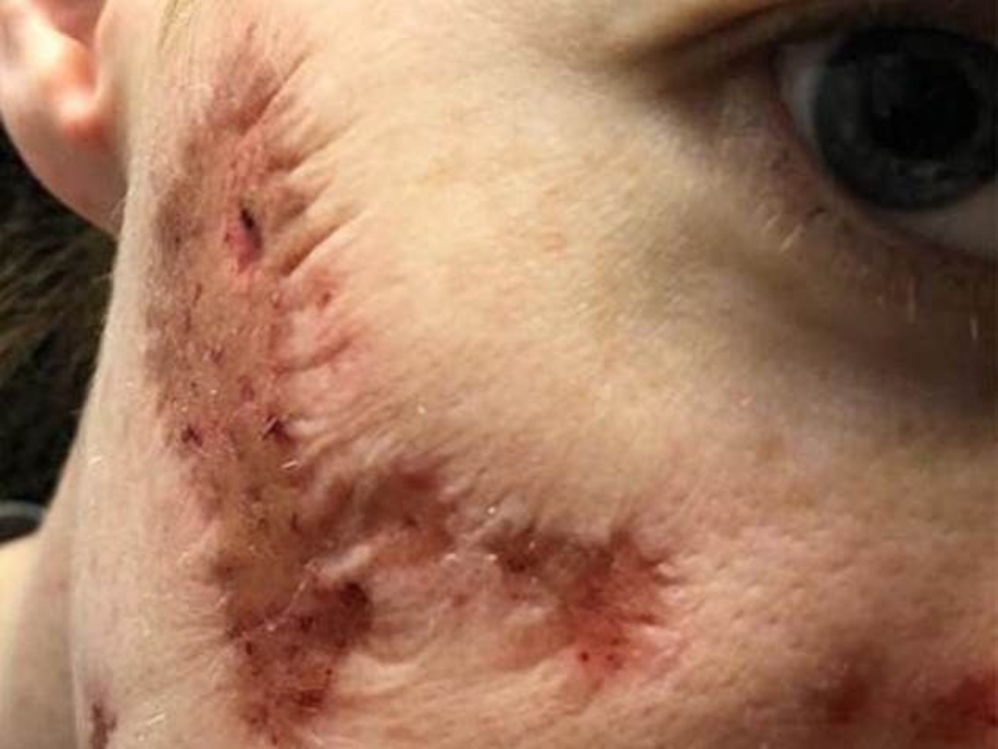 瑞秋使用公廁的洗手乳後，感染了致命的食肉細菌，臉開始腐爛變成坑洞，甚至出現「喪屍」般的臉頰。（圖／翻攝DailyMail）