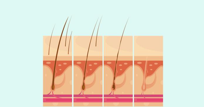 脂漏性毛囊炎掉髮　當心年節高熱量飲食復發
