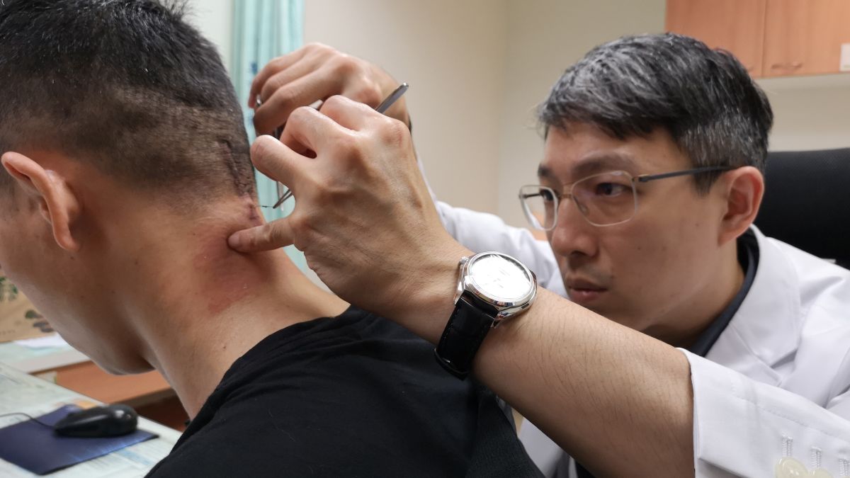 ▲越南移工罹患頸椎腫瘤壓迫有癱瘓危險，彰基神經外科孫立偉醫師診治，順利移除腫瘤。（圖／記者陳雅芳攝，2019.03.03）