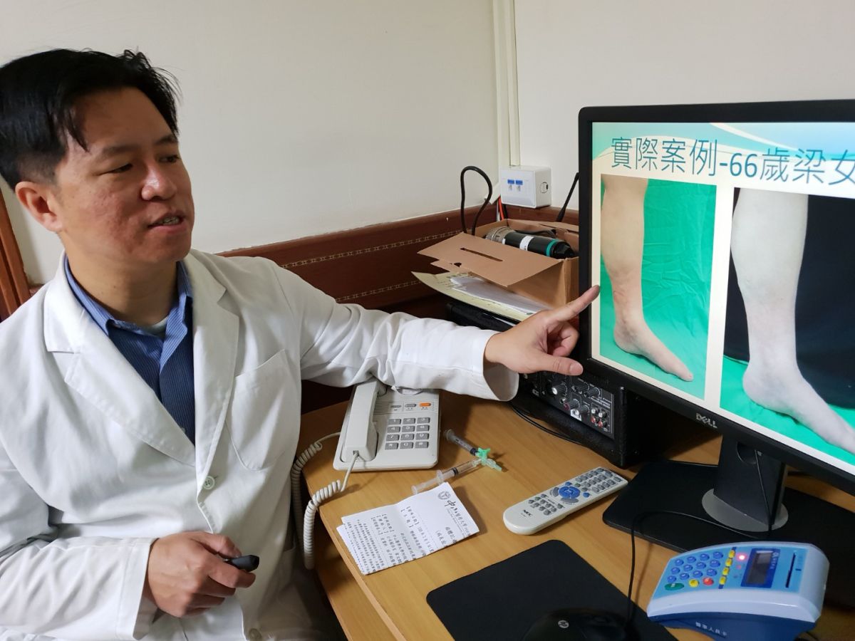 ▲中山附醫皮膚科醫師林子鈞說明，採用新式泡沫注射，不需開刀，效果顯著。（圖／金武鳳攝，2019.3.5)