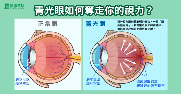 ▲青光眼是世界第2大致盲原因，研究報告顯示隨著人口老化，2020年全球的青光眼患者可能達8000萬人。（圖／健康傳媒製作）