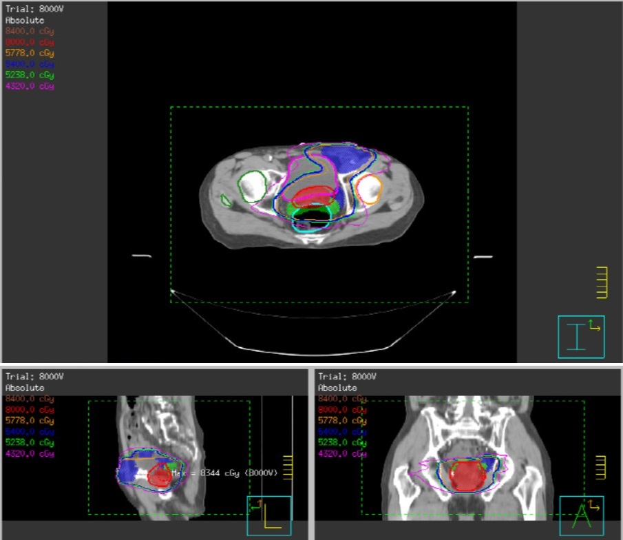 醫師表示，攝護腺癌喜侵犯儲精囊，淋巴擴散易在閉孔、內髂、外髂及薦前淋巴結等區，遠端轉移易攻擊骨頭。（圖／北市聯醫提供）