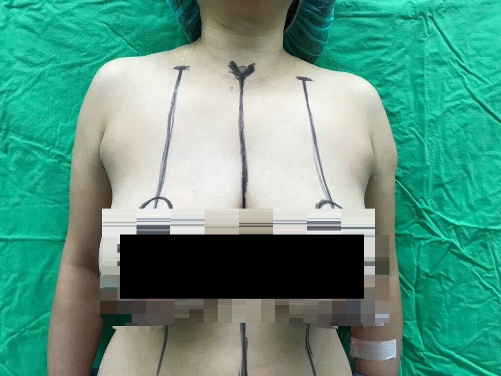 ▲婦人巨大胸部。 (圖／院方提供2019.3.14)