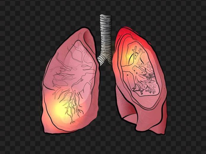 ▲結核病可能發生在你身體裡的任何器官或組織，最常見的就是肺結核。（圖／shutterstock.com）