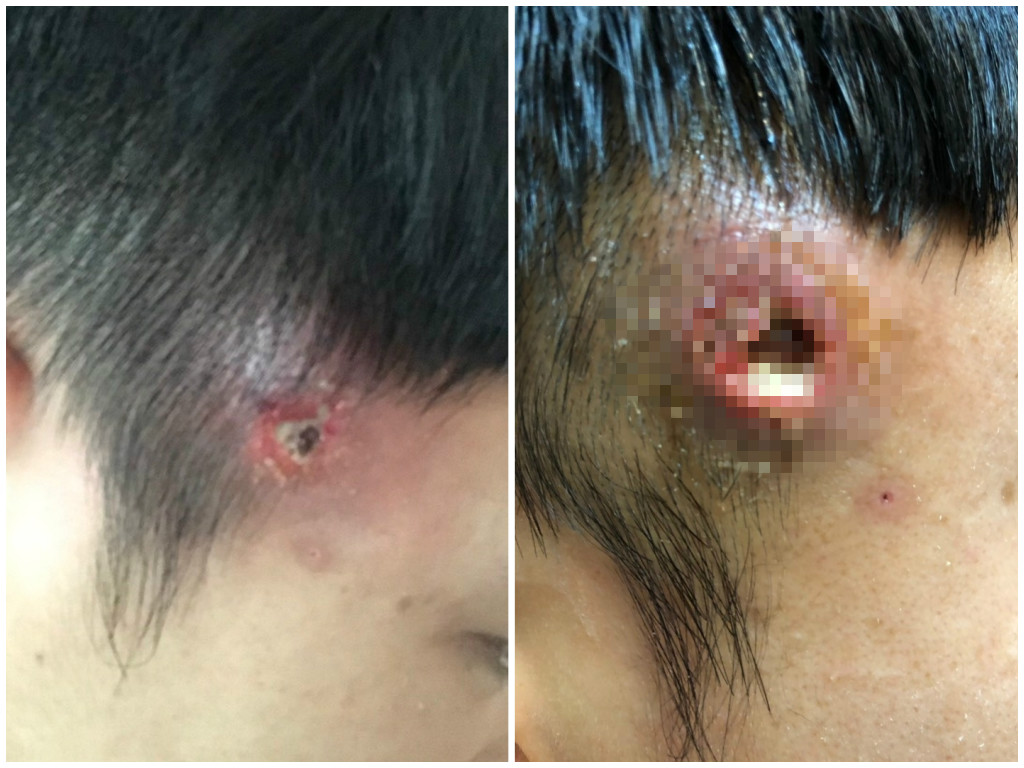 ▲男大生原以為太陽穴長痘痘，就醫才發現是嚴重的「疔瘡」。（圖／當事人授權使用）