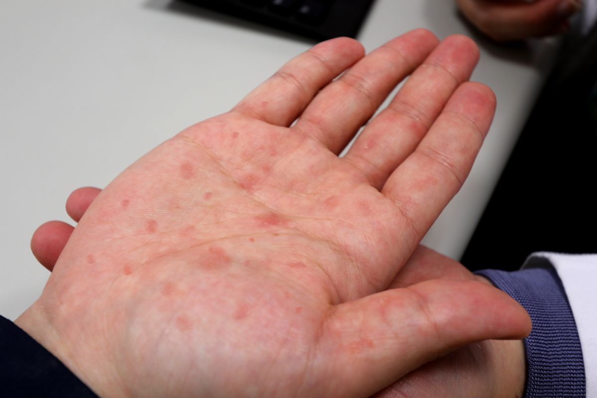 ▲3月14日白色情人節快到了，疾管署提醒「梅毒」在15歲至24歲的年輕族群激增，呼籲有不安全性行為應及早篩檢。圖為男子感染梅毒後手腳出現皮疹症狀。（示意圖／亞大醫院提供）