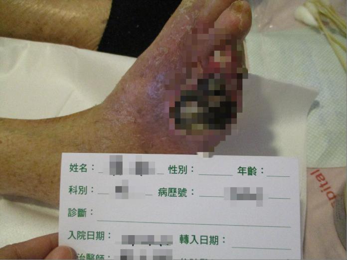 患高血壓的老婦被蚊子叮一口　抓癢破皮竟險截肢
