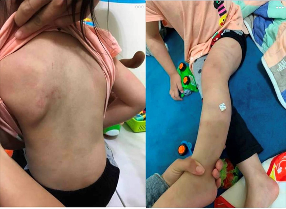 ▲女童遭劉姓繼父打得遍體麟傷。（圖／記者陳聖璋翻攝）