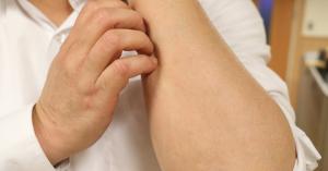 ▲異味性皮膚炎在台發生率10%，有很多潛藏的輕、中度案例。（圖／資料畫面）