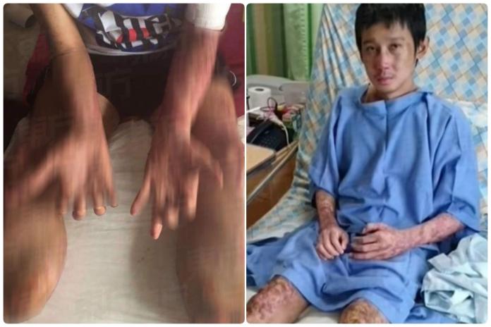 ▲泰國一名男子吃了「涼拌生豬血」，結果感染豬鏈球菌，最後雙腿截肢保命。（圖／翻攝網路）