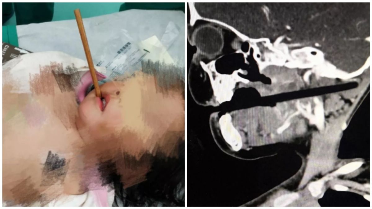 ▲大陸一名3歲女童吃飯時手持筷子在客廳奔跑玩耍，不慎跌倒，筷子插進顱內。（圖／翻攝網路）