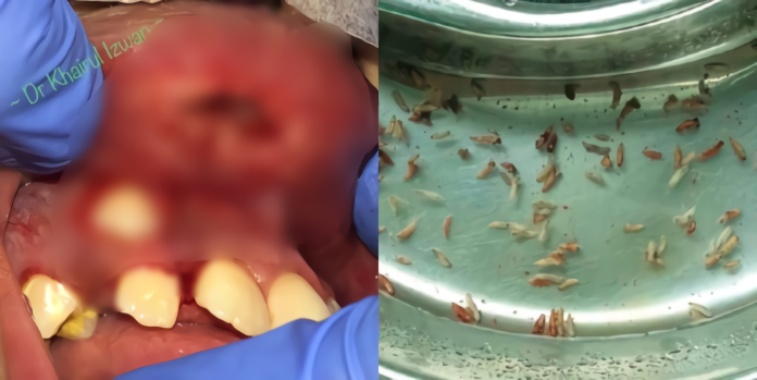 少女嘴唇遭蒼蠅產卵　驚見16條幼蟲少女媽急求醫
