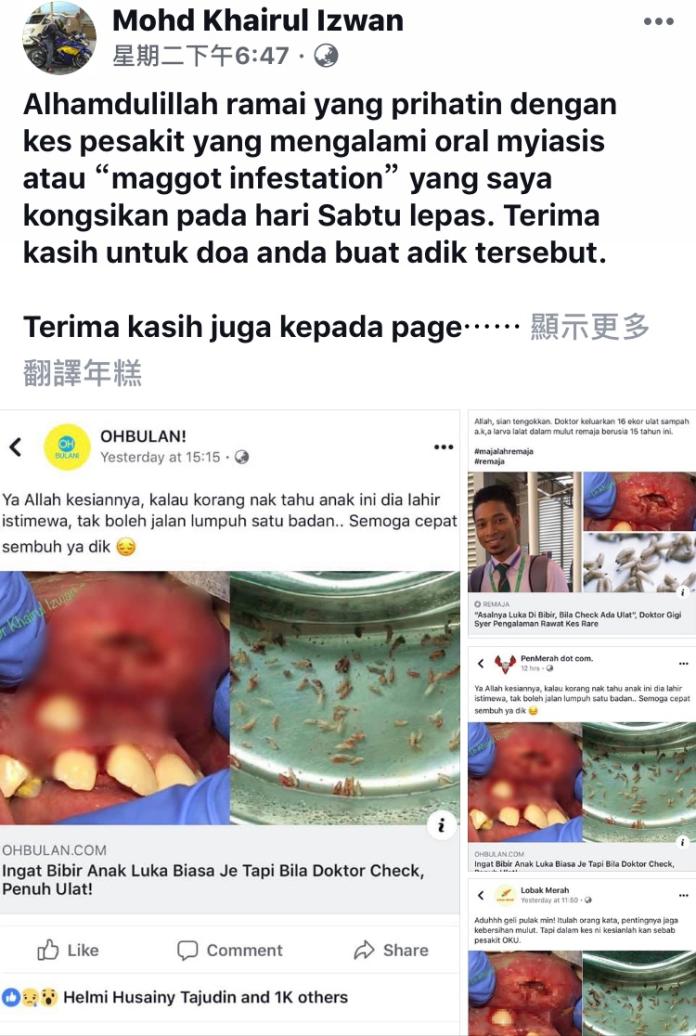 ▲馬來西亞牙醫（ Mohd Khairul Izwan ）在臉書上分享一則他負責的案例。（圖／翻攝 Mohd Khairul Izwan 臉書）