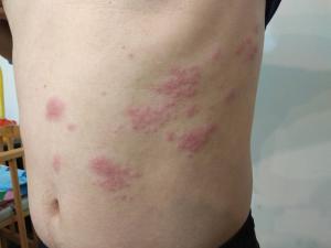 3類人帶狀皰疹風險更高！醫：疼痛恐持續數年
