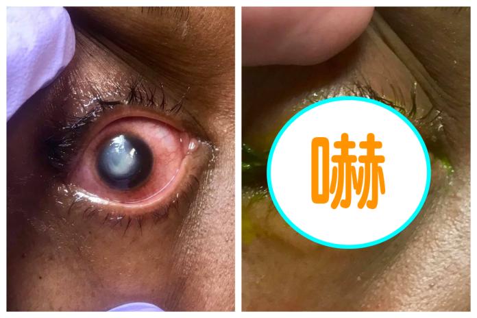 ▲美國一名眼科醫生沃爾默（Patrick Vollmer）在上月 29 日於臉書 PO 出一系列嚇人照片，顯示病患因戴隱形眼鏡睡覺而導致眼球流出「螢光淚」。（圖／翻攝自臉書「Vita Eye Clinic」）