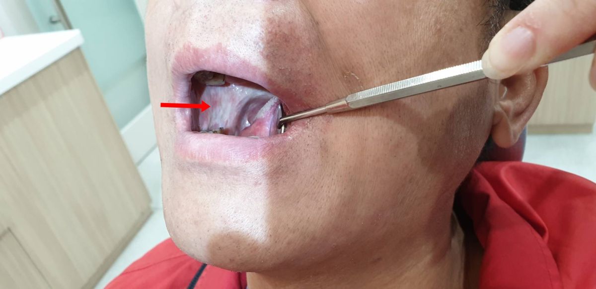 ▲一名男子發現舌頭內側破洞、疼痛 3 週後仍沒有痊癒，就醫檢查發現一處癌症腫瘤合併三處癌前病變！（圖／童綜合醫院提供）