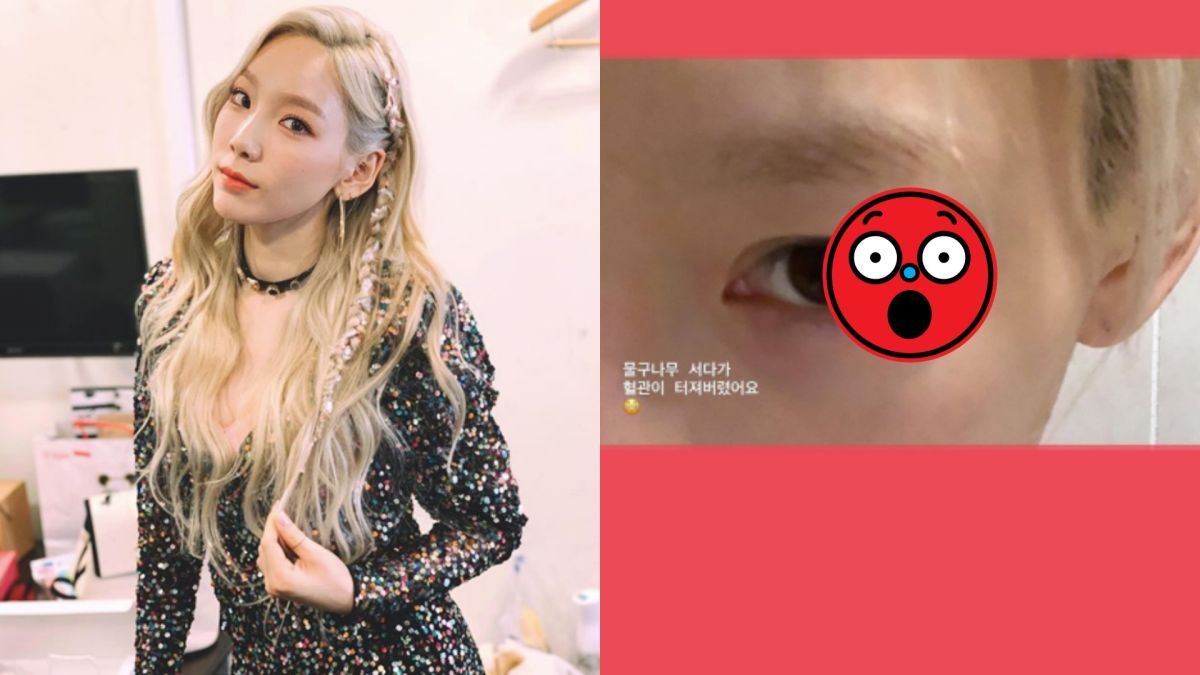 ▲太妍遭愛犬襲擊，讓她眼角血管裂掉。（圖／太妍IG）