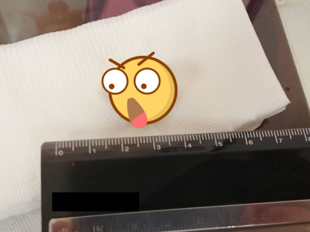 ▲喉嚨卡卡、口腔有異味，就醫檢查發現口腔 2 公分大的球狀物。（圖／改自亞大附屬醫院 ）